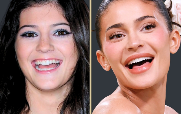 Hollywood Smile in Turkey: Your Guide to a Perfect Smile